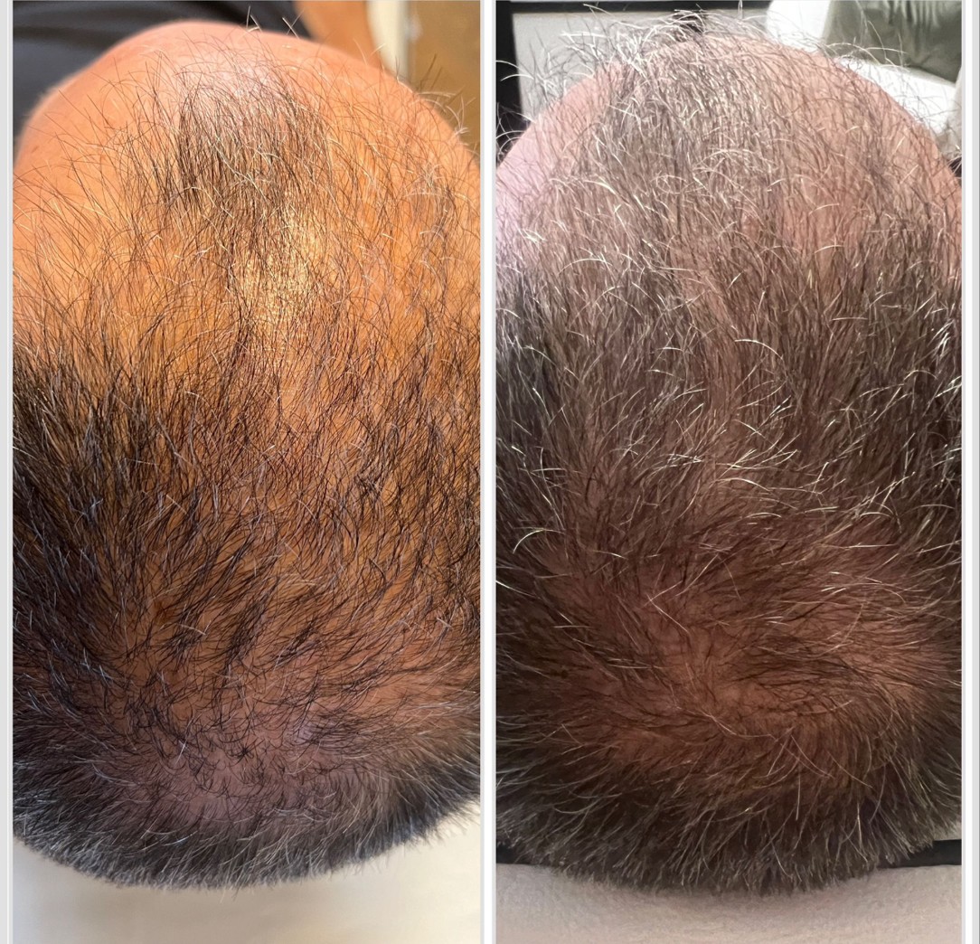 Hair restoration before and after at Cura Wellness
