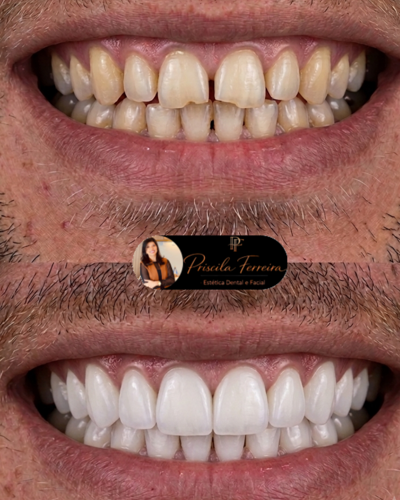Resultado facetas de resina - Caso 2 - Dra. Priscila Ferreira Goiânia