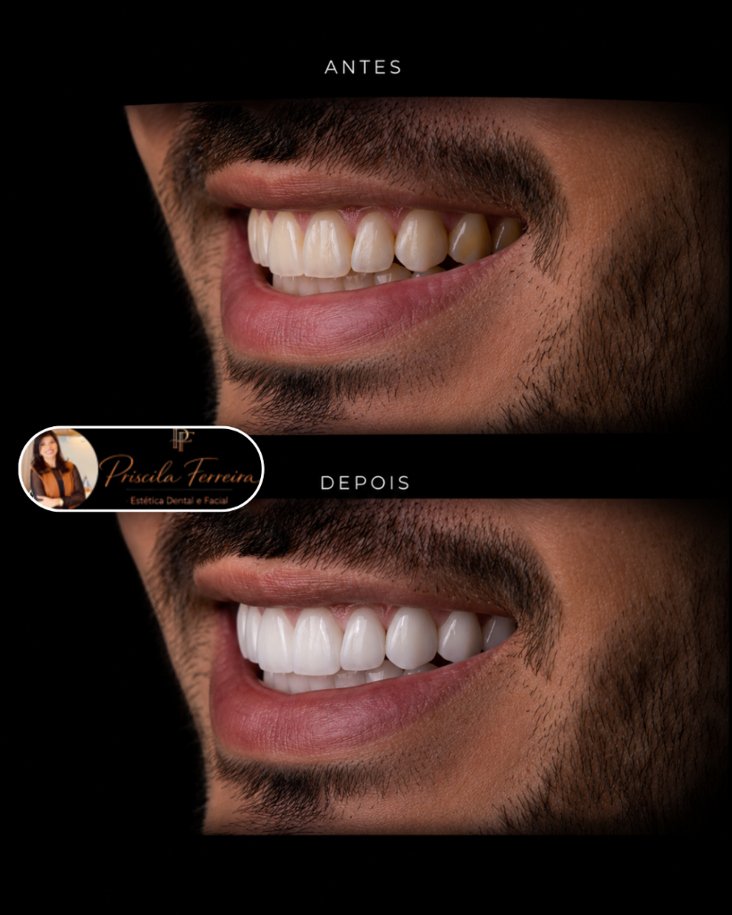 Resultado facetas de resina - Caso 5 - Dra. Priscila Ferreira Goiânia