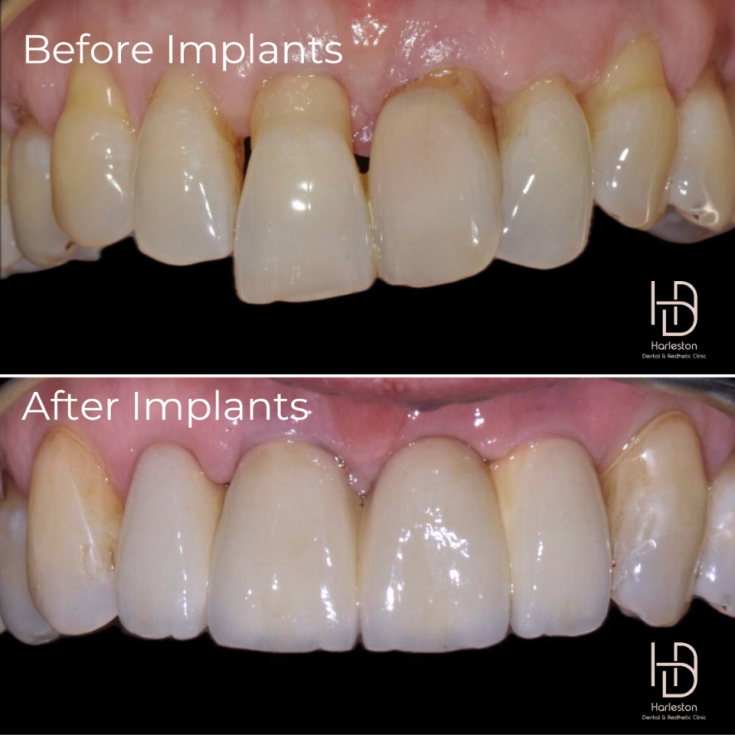 Dental implant before and after, Case Study One
