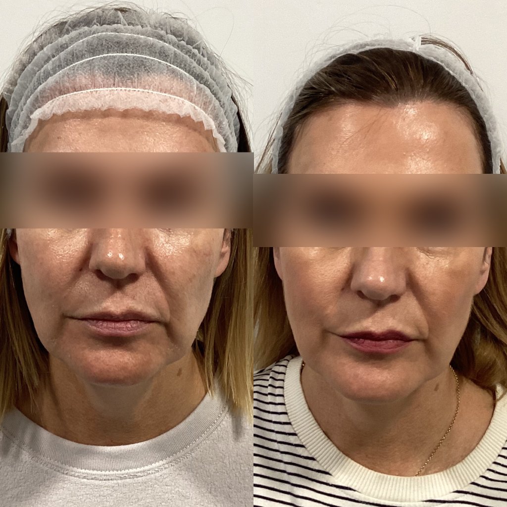 Anti-wrinkle injections before and after, Case Study Two
