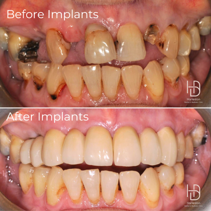 Dental implant before and after, Case Study Two
