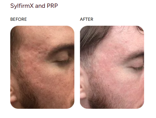 Before and after case study, SylfirmX & PRP