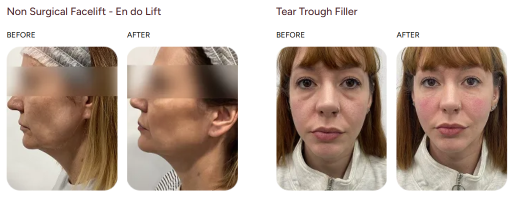 Before and after case study, Endo Lift & Tear Trough Filler