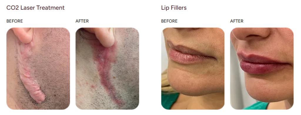 Before and after case study, CO2 Laser & Lip Fillers