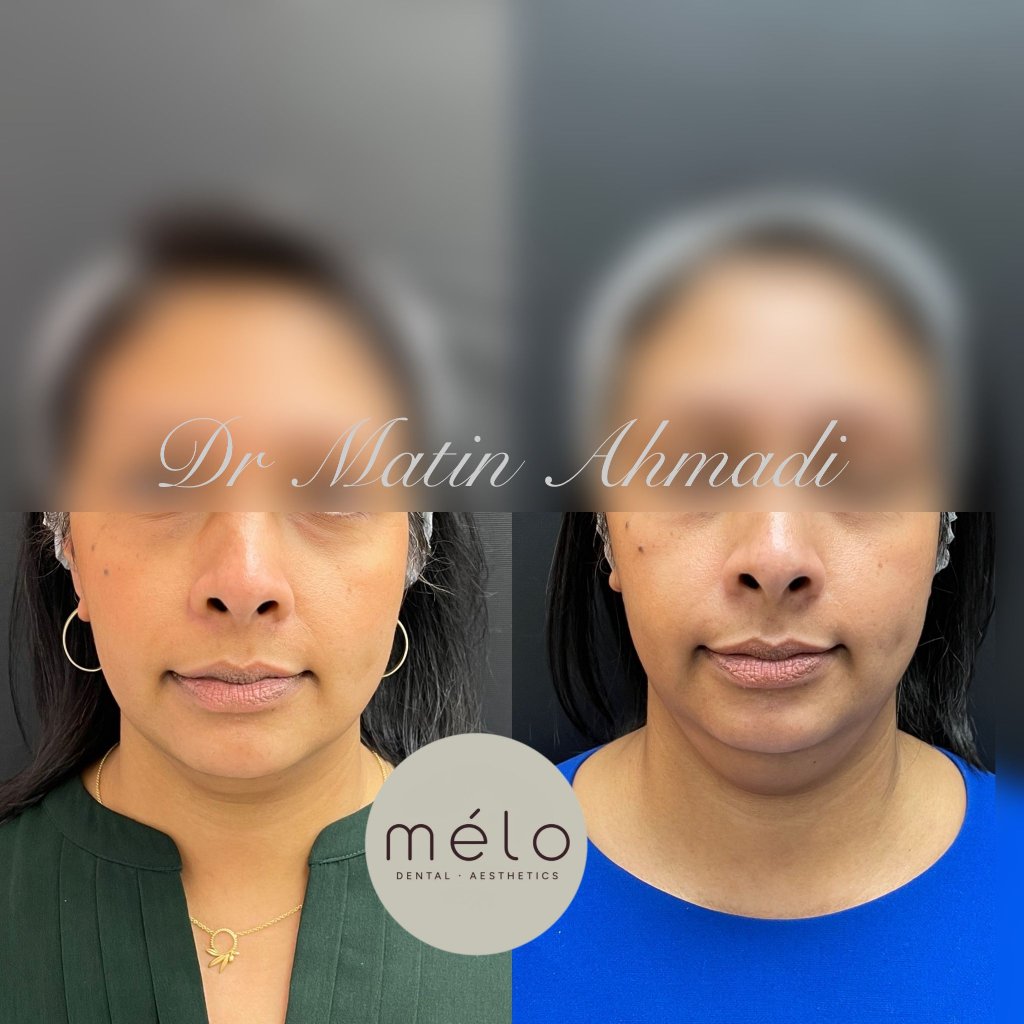 Anti-wrinkle injections before and after, Case Study Three