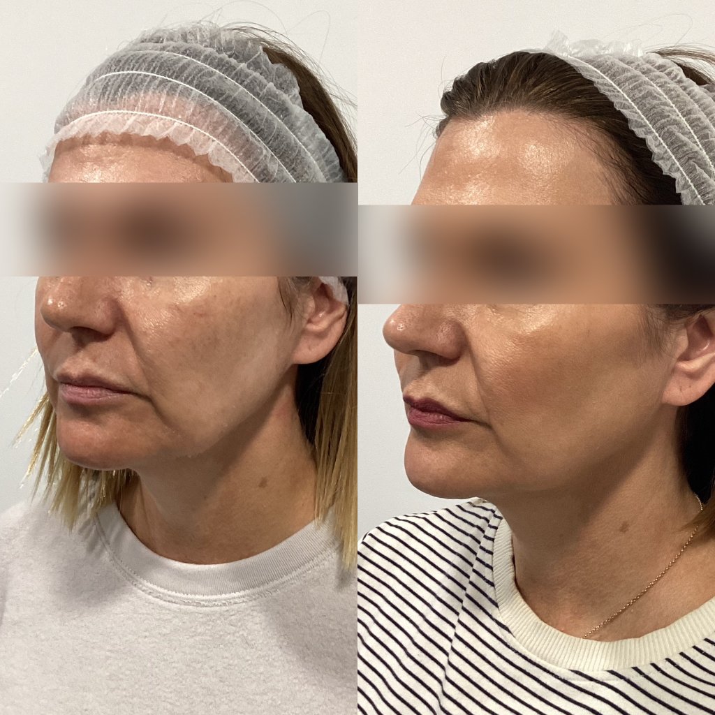 Anti-wrinkle injections before and after, Case Study One