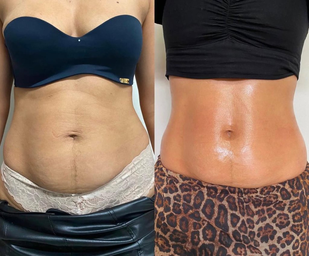 Resultado corporal antes e depois