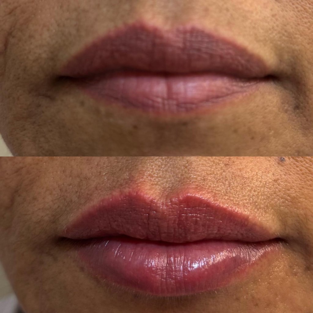 Tratamento facial resultado