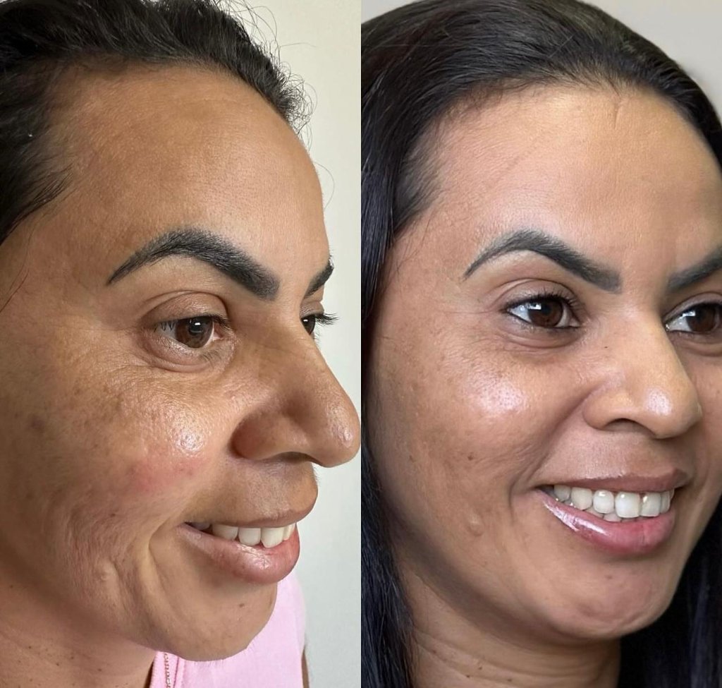 Harmonização Facial, Botox, Preenchimento