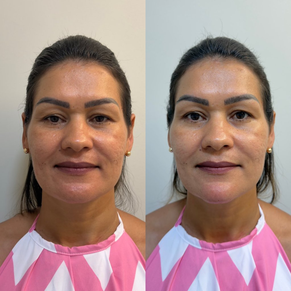 Botox, Bioestimulador