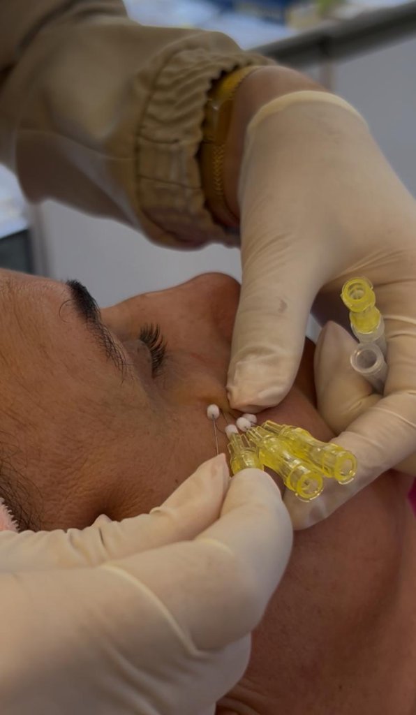 Tratamento facial resultado