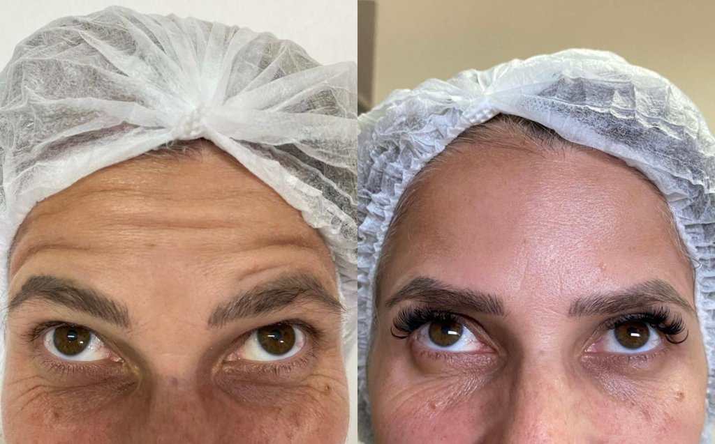 Tratamento facial resultado