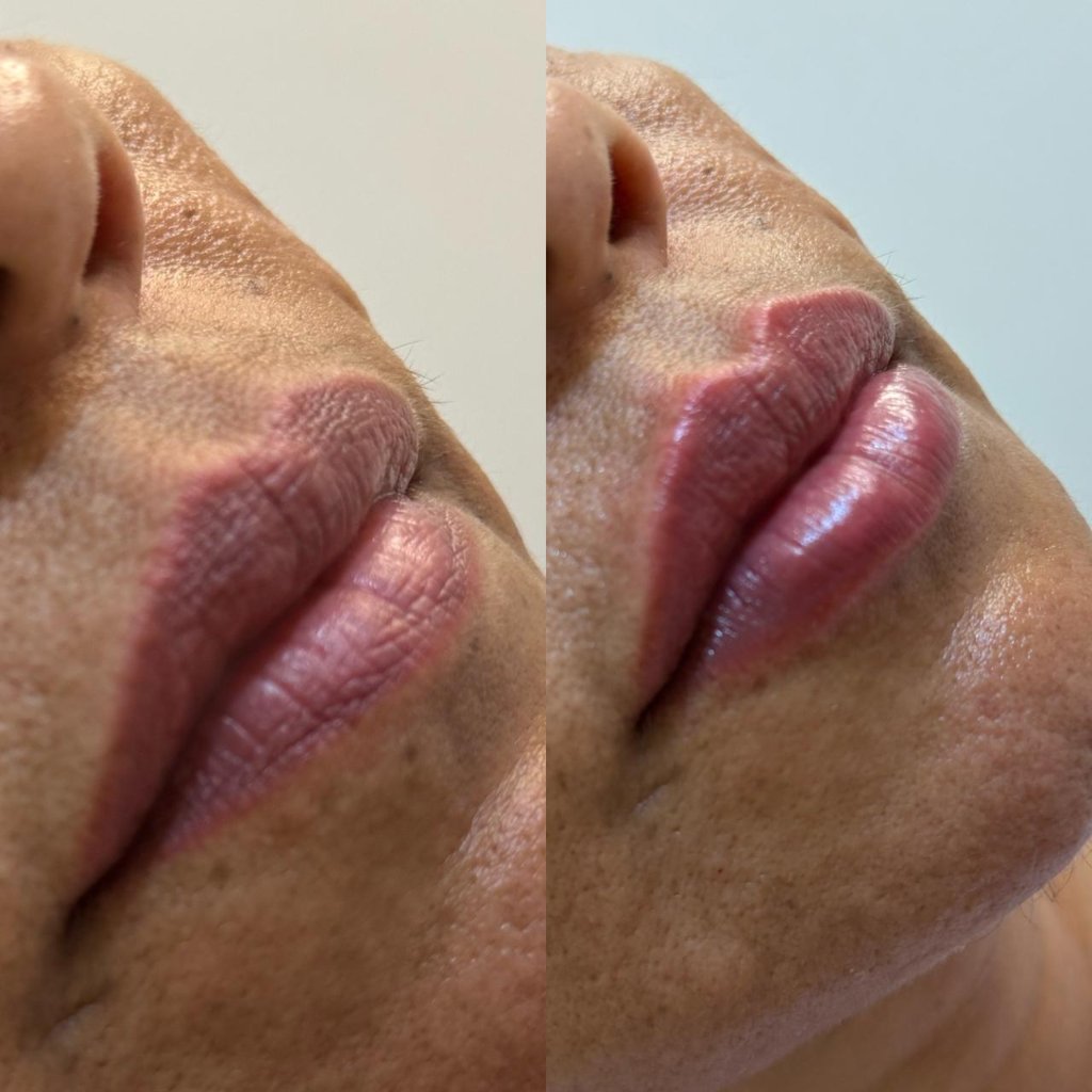 Tratamento facial resultado