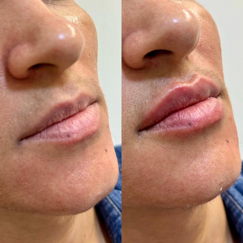 Tratamento facial resultado