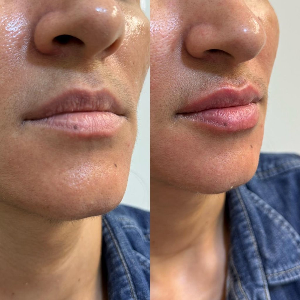 Tratamento facial resultado