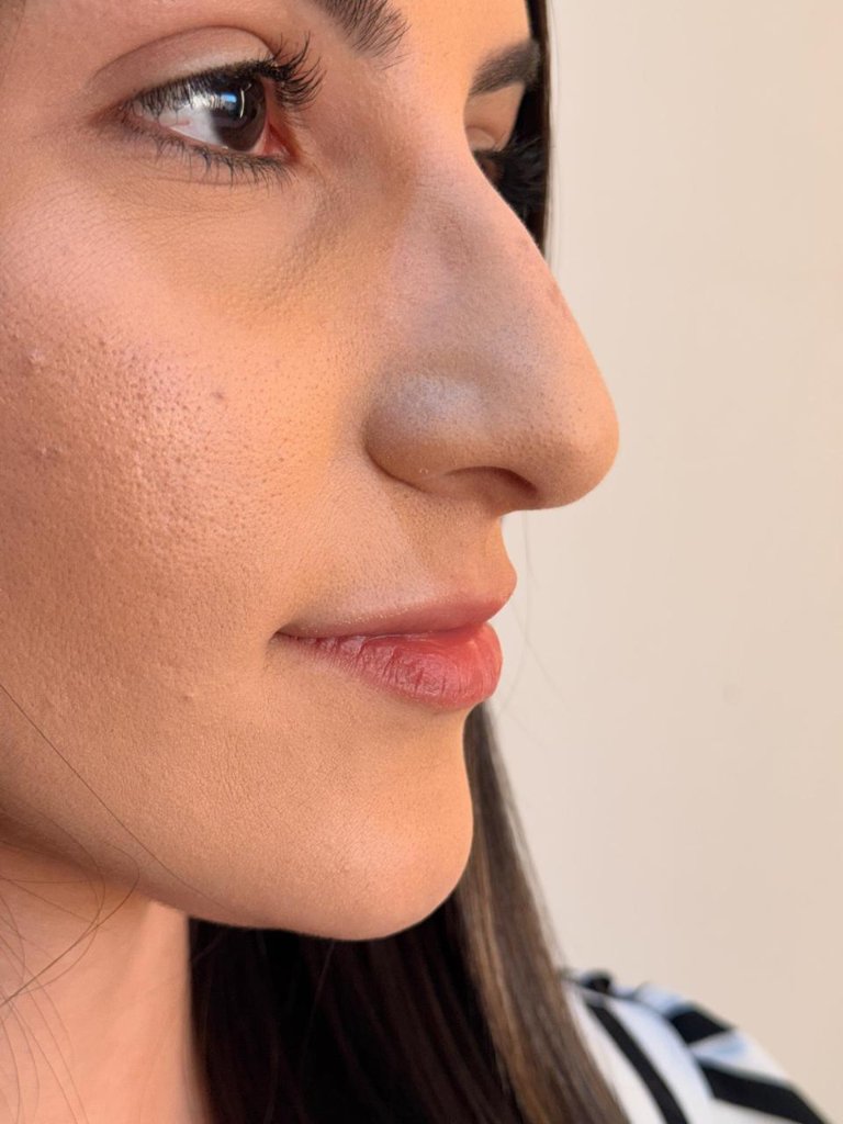 Tratamento facial resultado