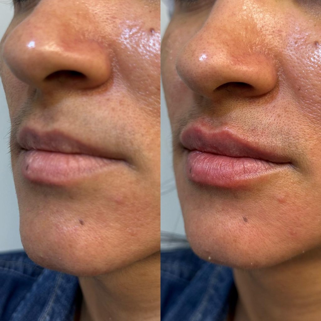Tratamento facial resultado