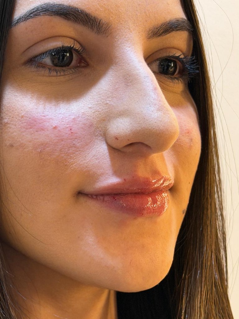 Tratamento facial resultado