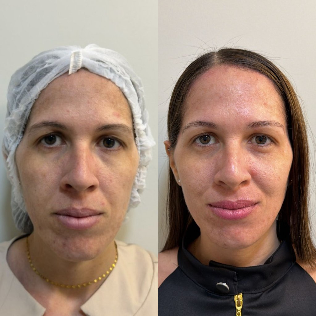 Harmonização Facial, Skinbooster