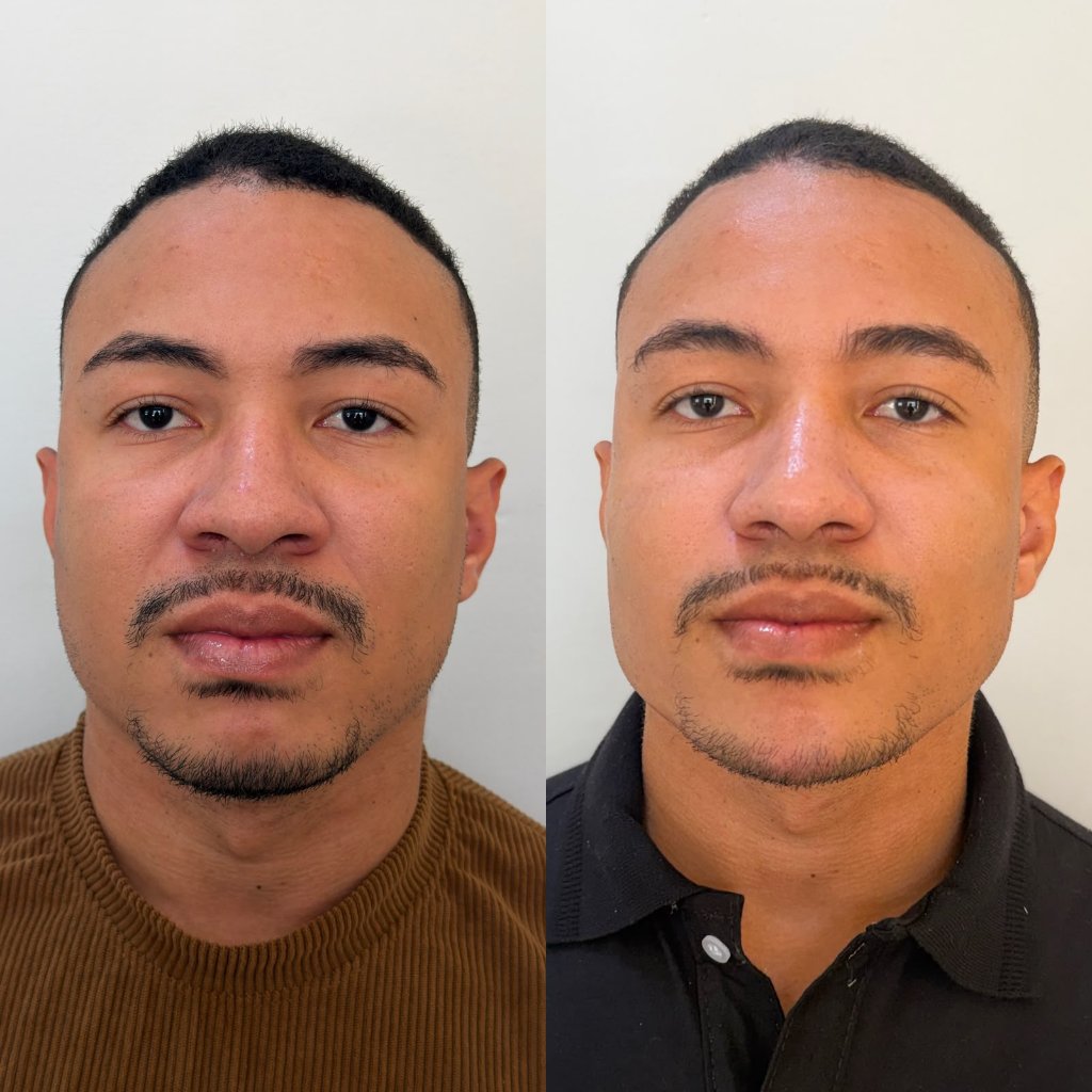 Harmonização Facial Masculina, Botox