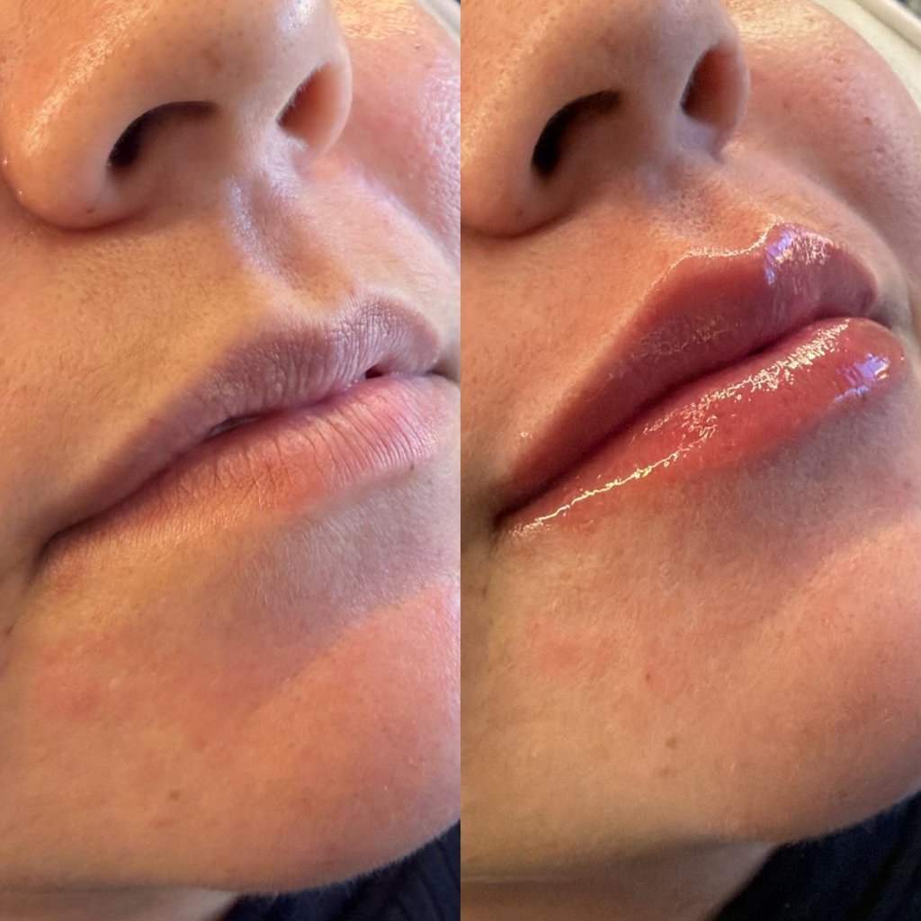 Preenchimento Labial