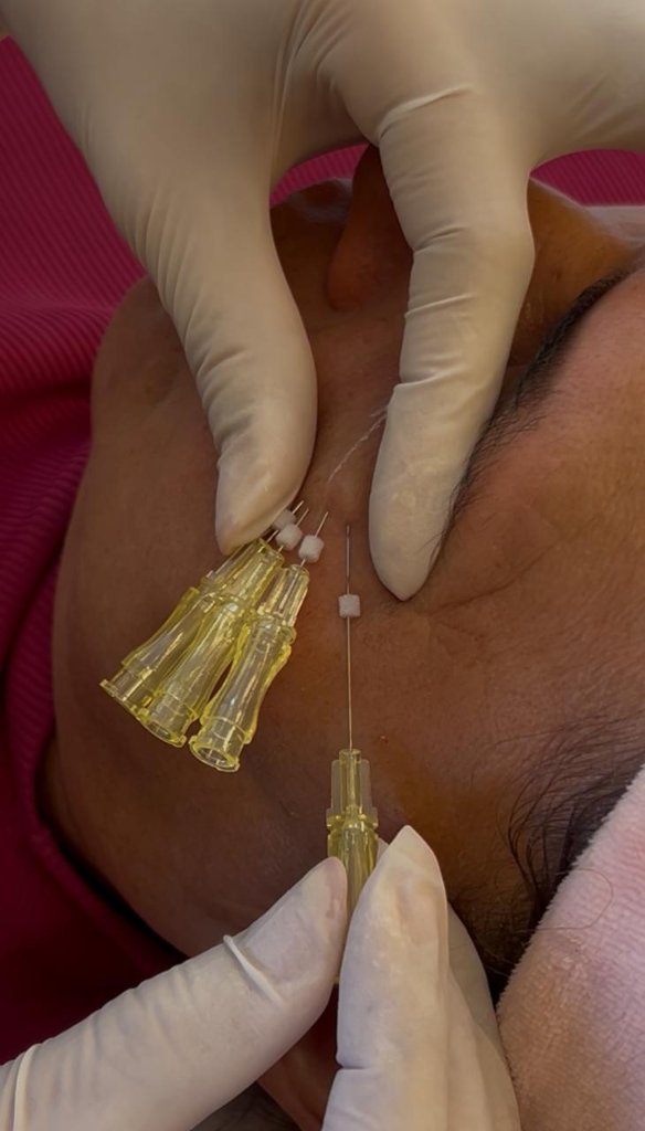 Tratamento facial resultado