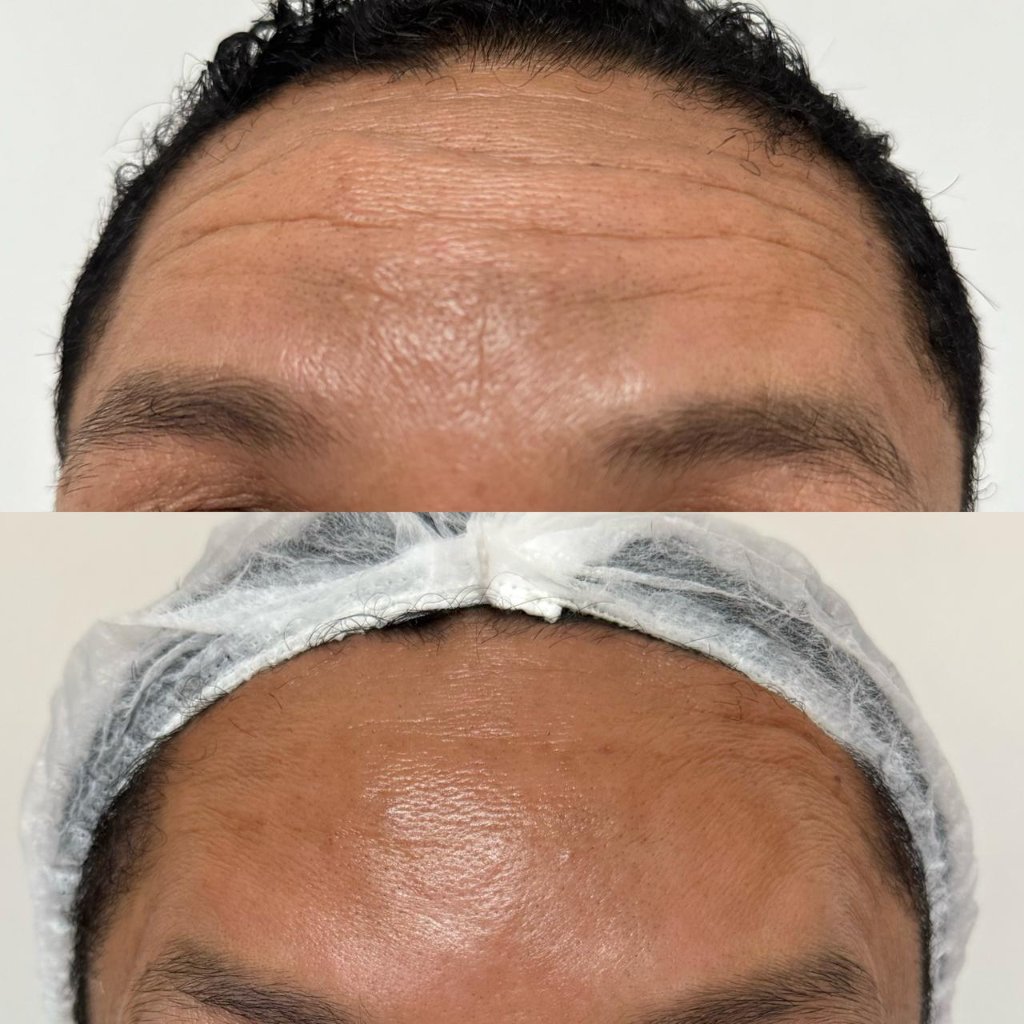 Tratamento facial resultado
