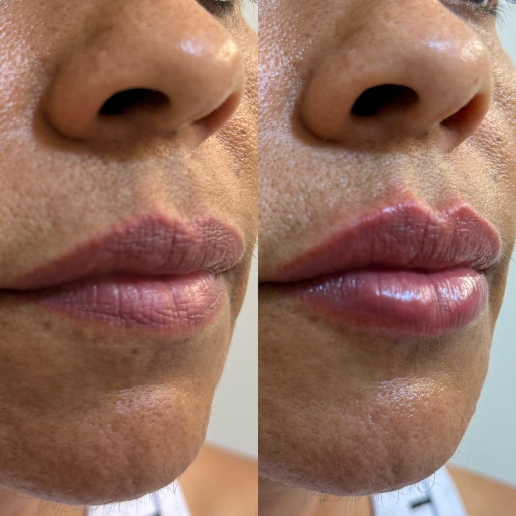 Tratamento facial resultado