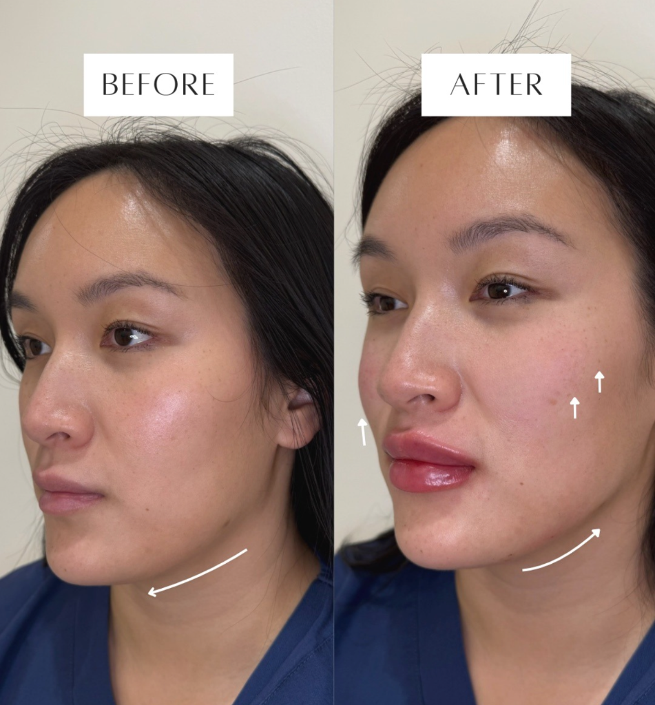 Botox Cost in Massachusetts: 2026 Pricing Guide
