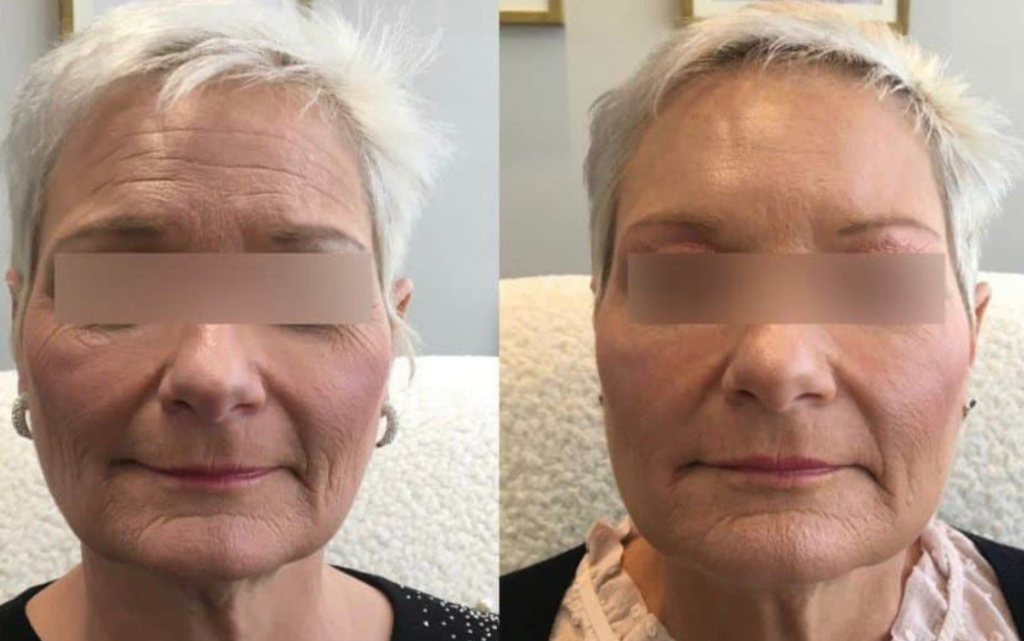 Lip Filler Cost in Massachusetts