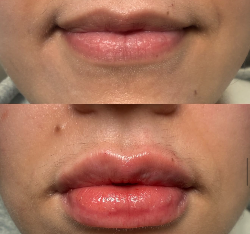 Botox for Neck Bands in Massachusetts