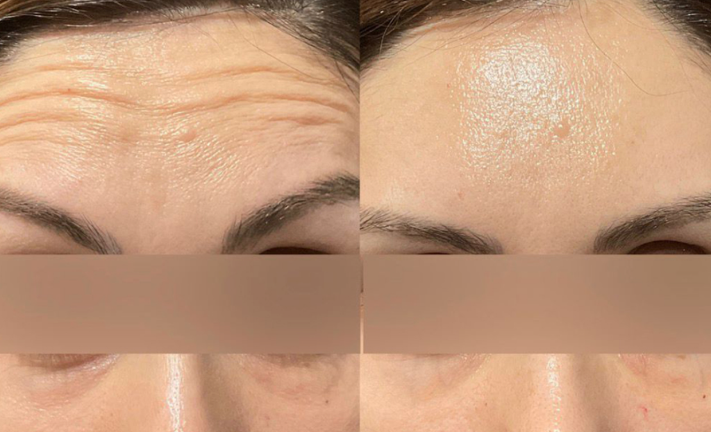 Botox for Crow's Feet in Massachusetts