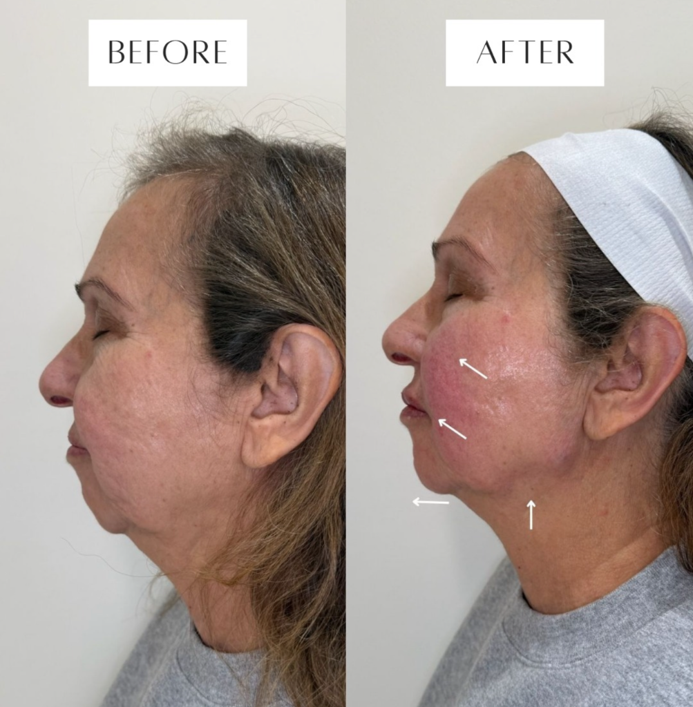 Botox for Frown Lines (11s) in Massachusetts
