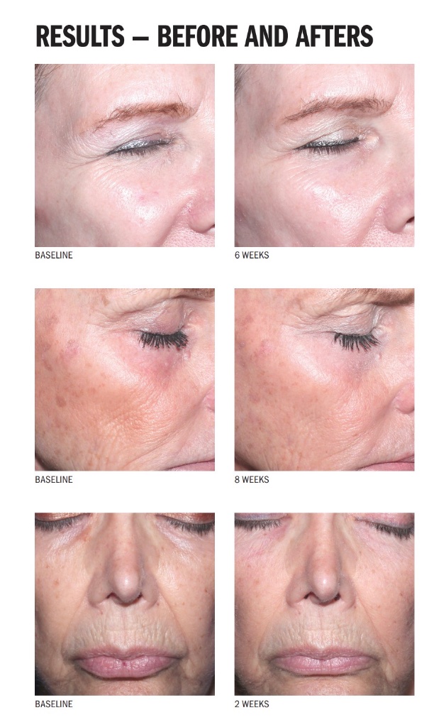 Skin tightening device before and after results