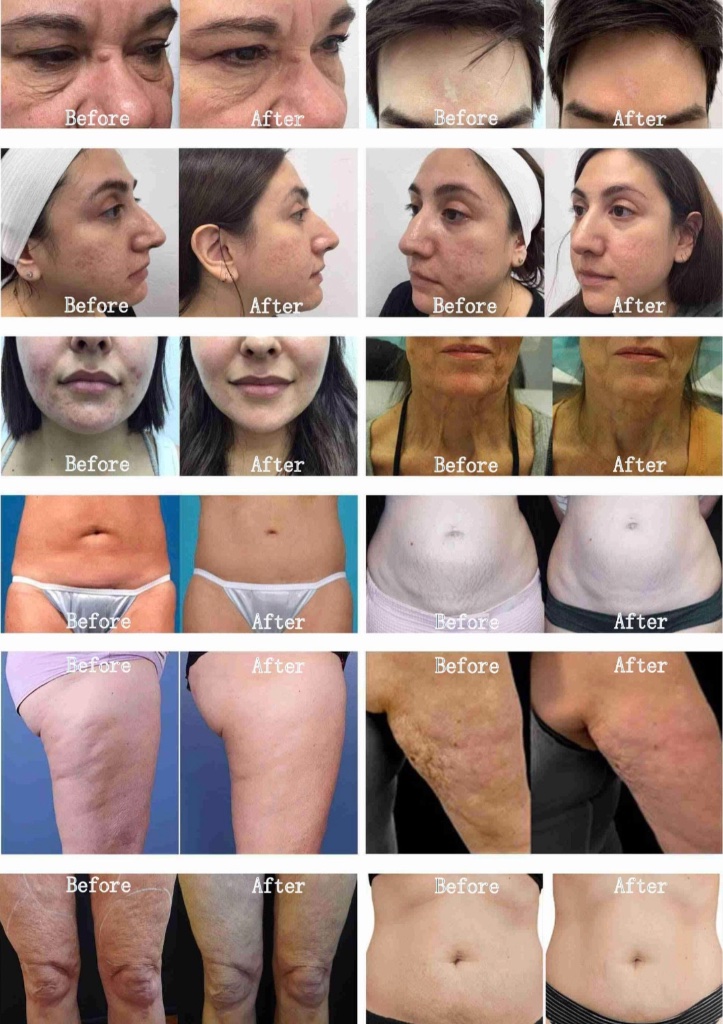 Before and after clinical results — face, neck and body