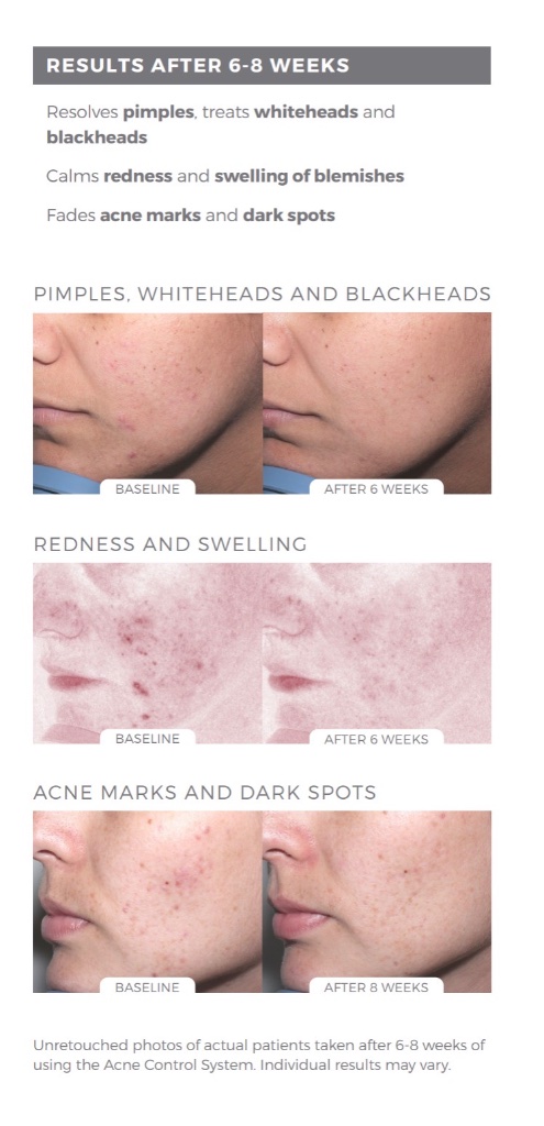 Clinical before and after results — Acne Control System