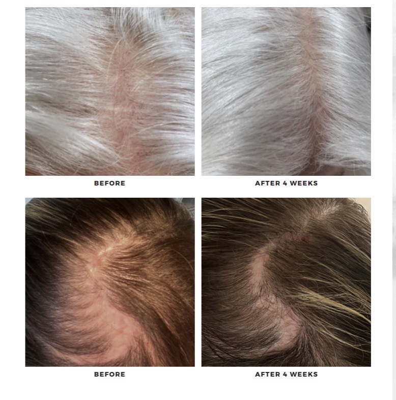 DensiGrowth before and after six weeks results