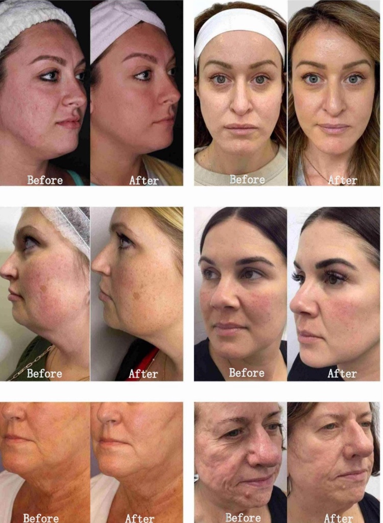 Effect comparison diagram before and after treatment