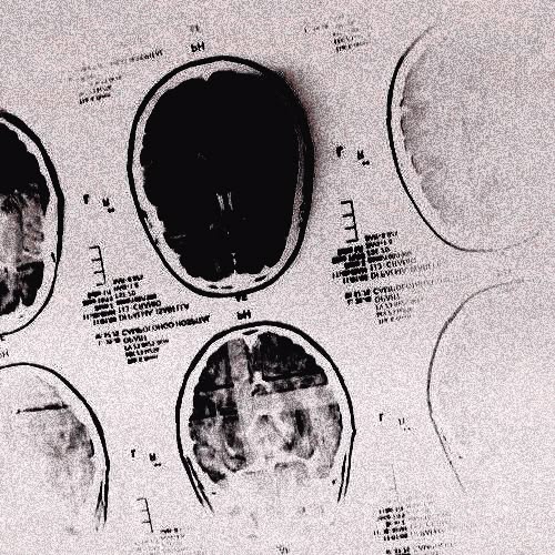 Archival MRI brain scan printout with multiple cross-sectional views