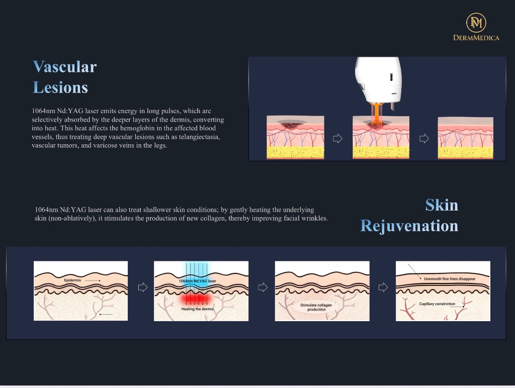 Vascular lesion treatment and skin rejuvenation with 1064nm Nd:YAG