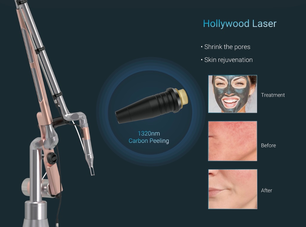 Hollywood Laser — 1320nm Carbon Peeling treatment