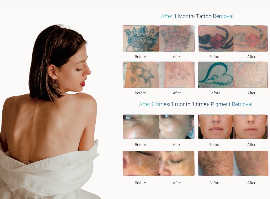 DermMedica Pico Pro before and after tattoo and pigment removal results