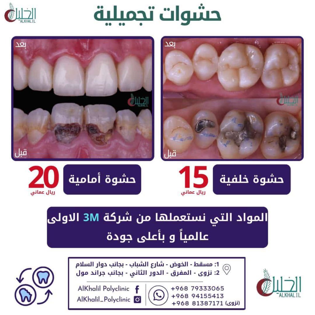 Fillings result at Alkhalil Dental Center in Muscat, Oman