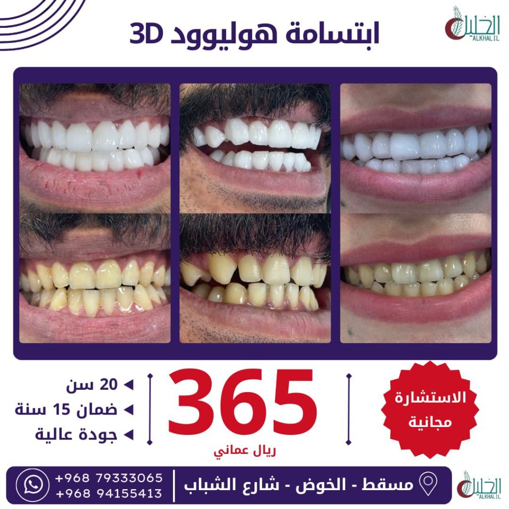 Hollywood Smile transformations at Alkhalil Dental Center in Muscat, Oman