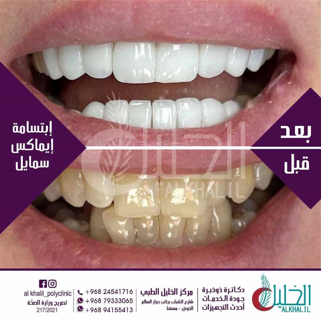 Emax Veneers result at Alkhalil Dental Center in Muscat, Oman