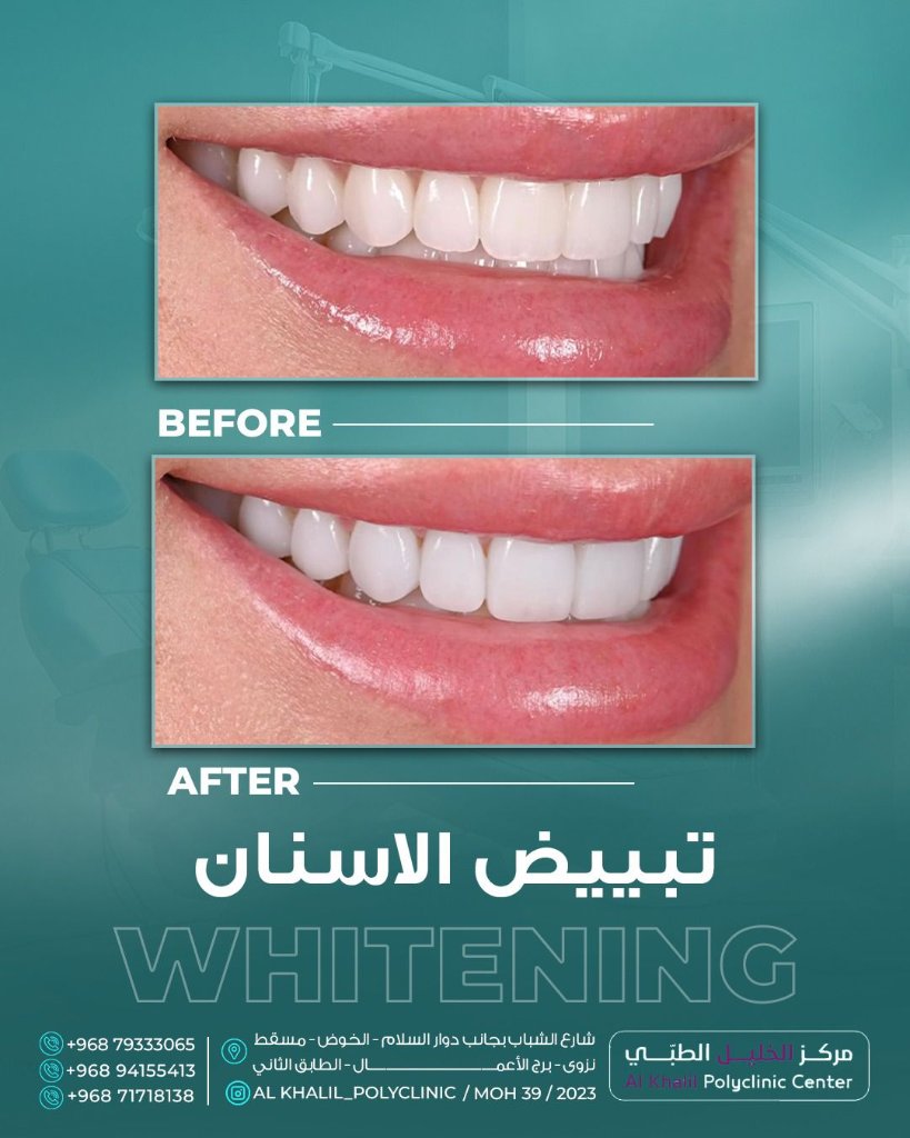 Teeth whitening results at Alkhalil Dental Center in Muscat, Oman