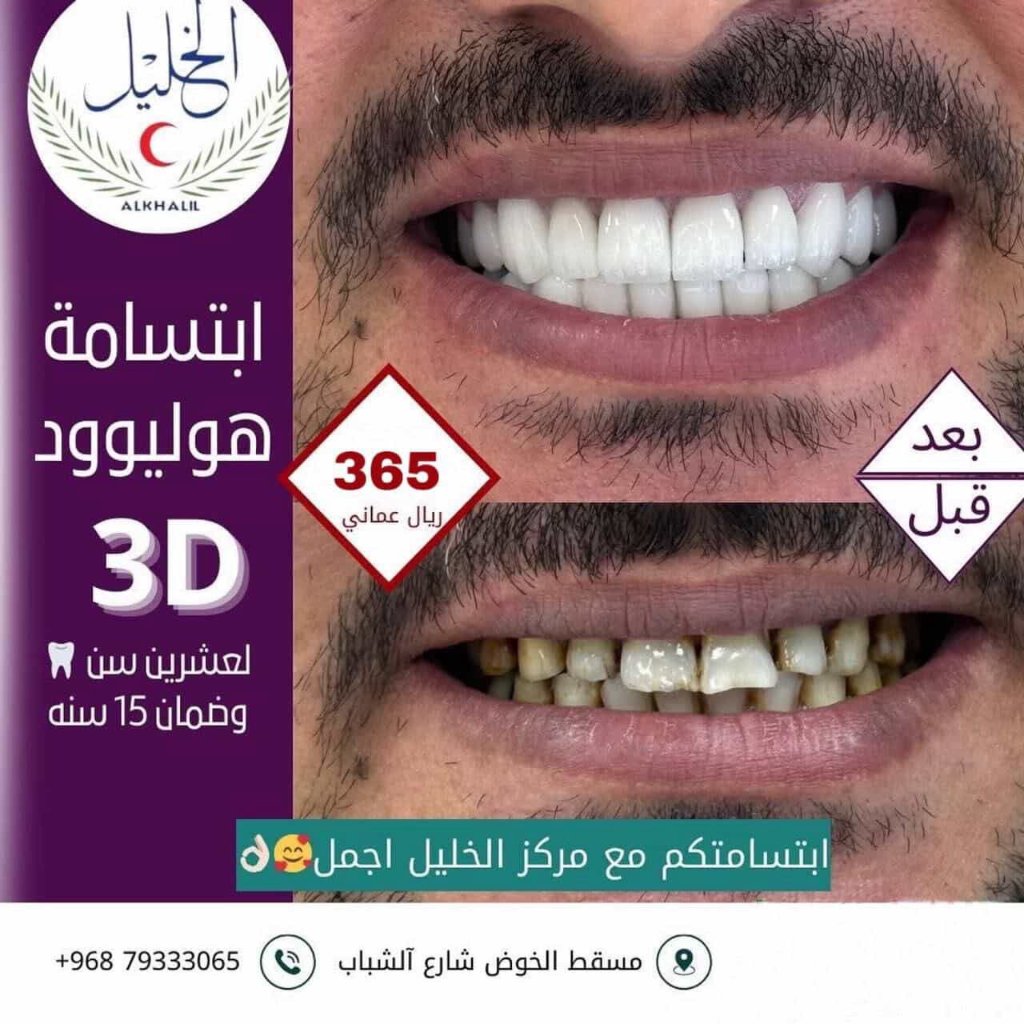 Hollywood Smile transformation at Alkhalil Dental Center in Muscat, Oman