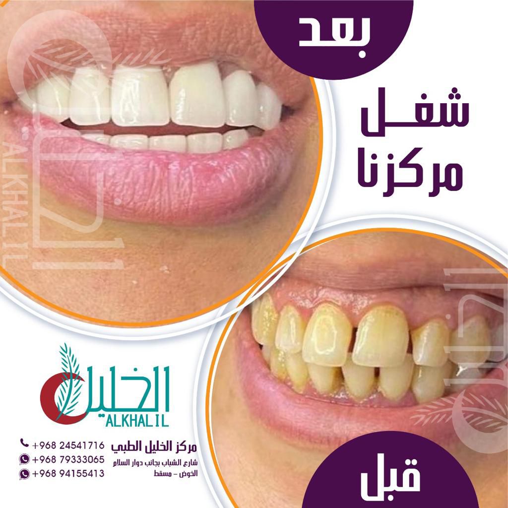 Before and after Hollywood Smile transformation at Alkhalil Dental Center in Muscat, Oman