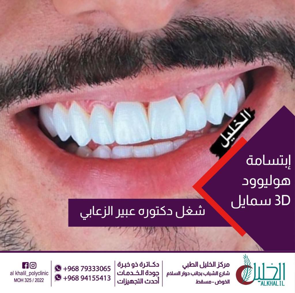 Hollywood Smile result at Alkhalil Dental Center in Muscat, Oman